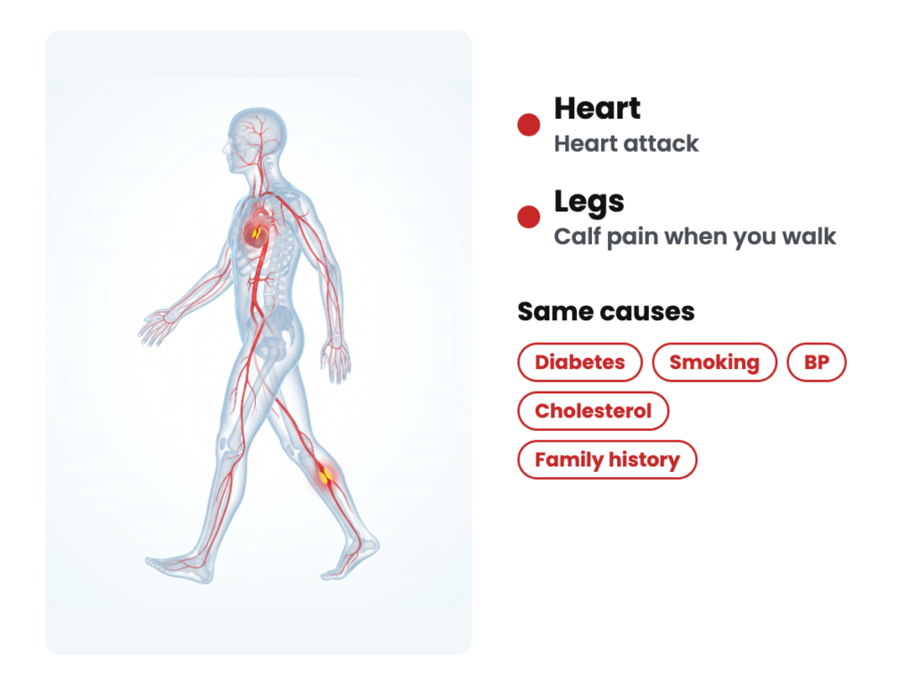A see-through walking body with red arteries, a block glowing in the heart and another in the calf, beside the five shared causes: diabetes, smoking, BP, cholesterol and family history.